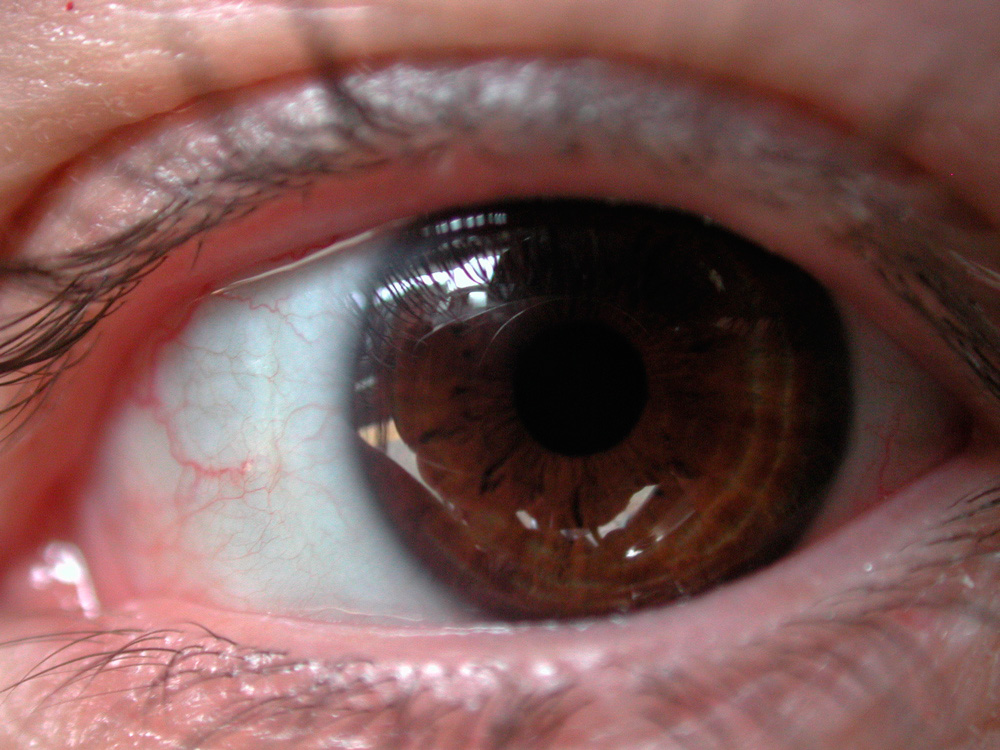 hilary eye