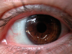 hilary eye